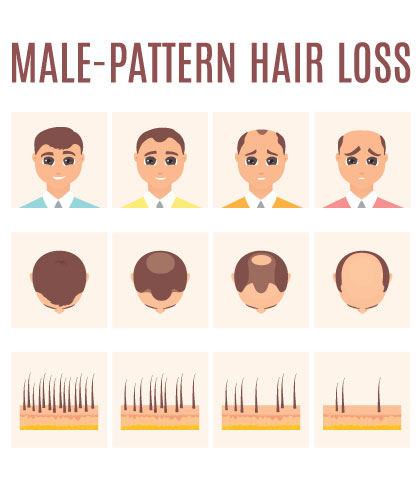 Hair Loss in men 4