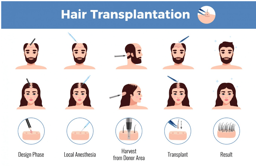 Hair Transplant vs. Hair Restoration 3