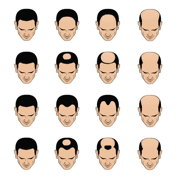 Male Pattern Baldness 2