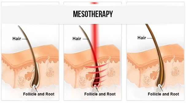 Mesotherapy 1 1