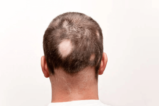 Treatments for alopecia