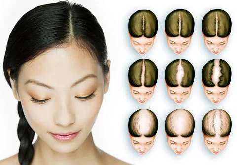 female pattern baldness 1