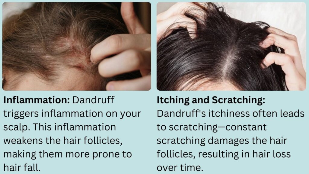 Dandruff Cause Hair Loss