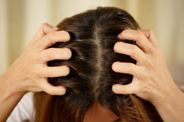 Dandruff Cause Hair Loss