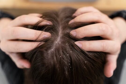 Dandruff Cause Hair Loss