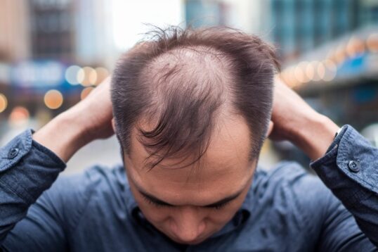 Vitamin B12 Deficiency Can Cause Hair Loss